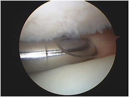 Obraz artroskopowy chondromalacji chrząstki podczas wykonywania tzw. shavingu.