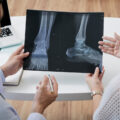 Ortopeda ogląda zdjęcie RTG stóp. Stopa wydrążona — częste objawy i sposoby leczenia
