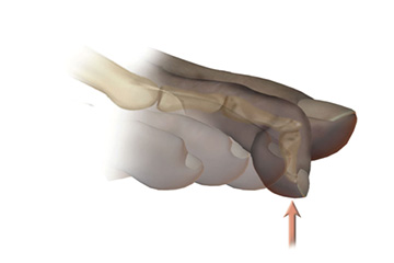ortopedia-stopa-palce-mlotkowate-04