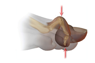 ortopedia-stopa-palce-mlotkowate-05