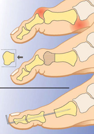 ortopedia-stopa-palce-mlotkowate-09